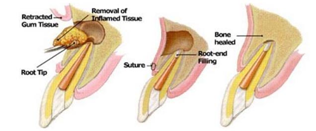 apicoectomy-procedure