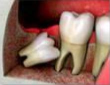 impacted-tooth