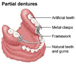 partial-dentures