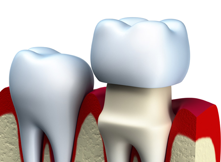 dental-crown