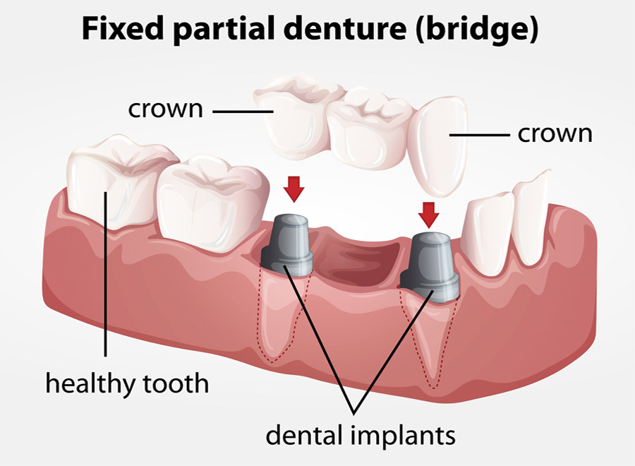 fixed-partial-denture