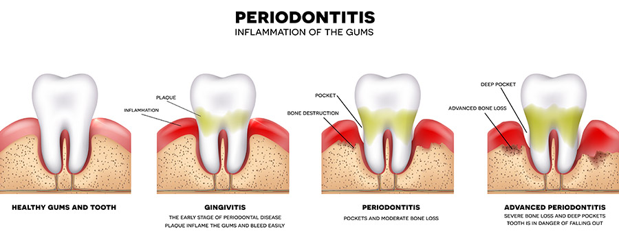 inflammation-gums-illustration