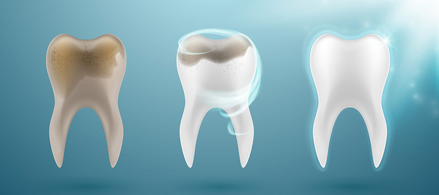 progress-tooth-cleaning-illustration