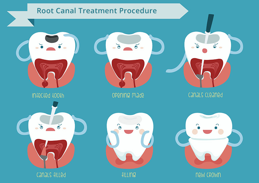 root-canal-treatment-procedure