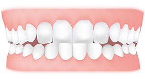 anterior-crossbite-underbite