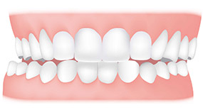 crossbite