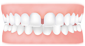 diastema