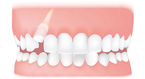 impacted tooth