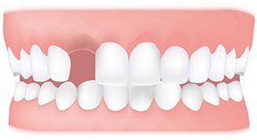 missing tooth