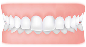 overbite
