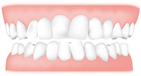 overcrowded teeth