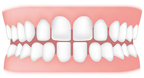 Gaps between teeth - spacing